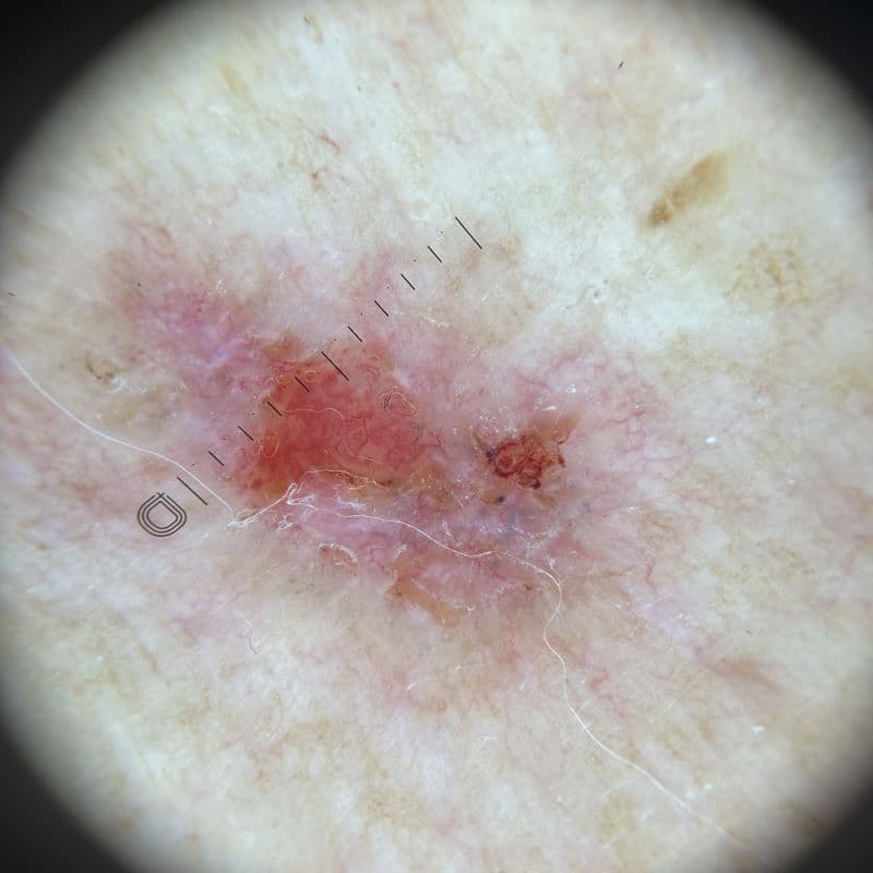 Basal Cell Carcinoma (BCC)