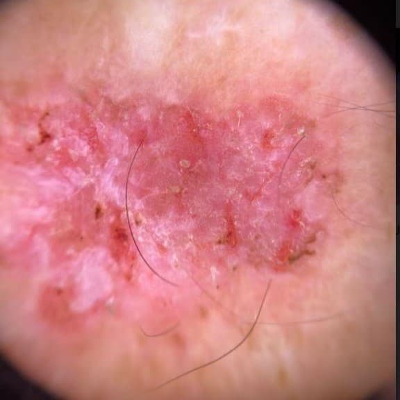 Squamous Cell Carcinoma (SCC)