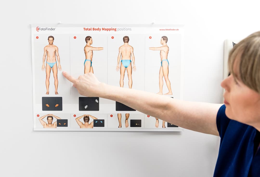 ABCDEs of Melanoma Screening