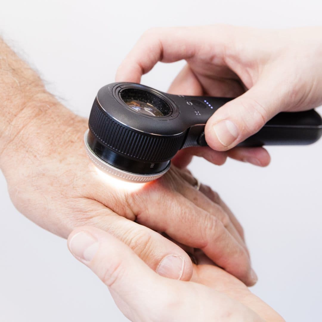 Image of dermoscopy tool being used on a client hand for cancer screening